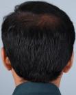 After Hair Transplant&nbsp;Midscalp